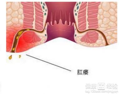 肛瘘最新治疗步骤指南及解析